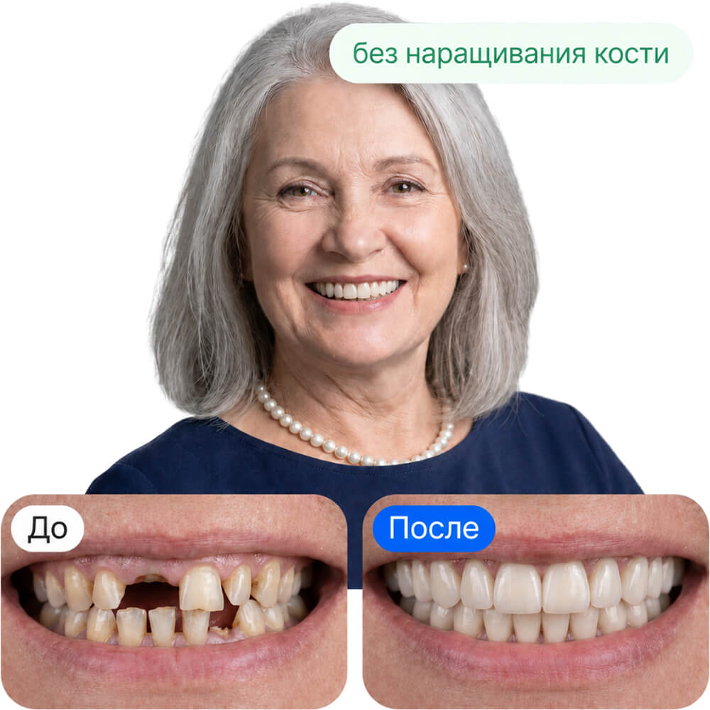 Все зубы на 4 имплантах, классический протез
